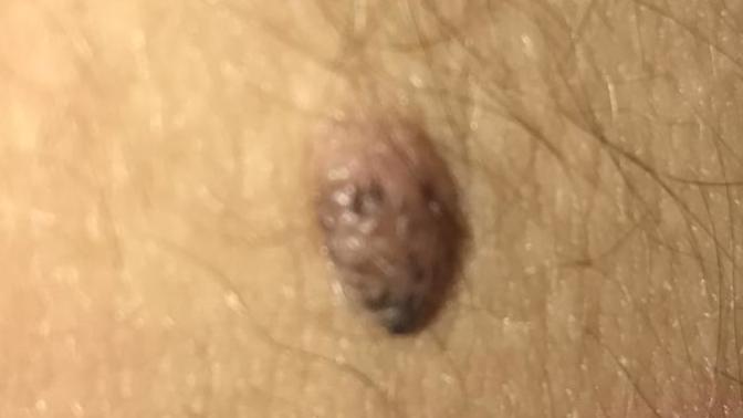 Vücudumdaki ben’in üzerinde siyahl lekeler var Kanser riski taşıyan ben midir? Korkuyorum, Doktorlar, Tıp okuyanlar nolur?