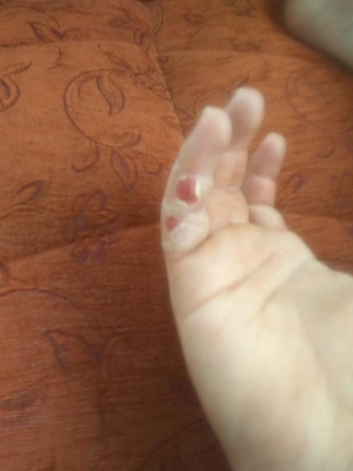 Bu açık yara ne zamana kadar eski halini alır yara bandı ile kapatılması uygunmu?