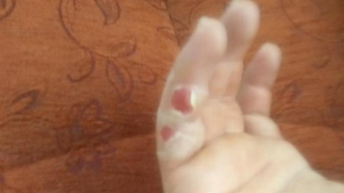 Bu açık yara ne zamana kadar eski halini alır yara bandı ile kapatılması uygunmu?