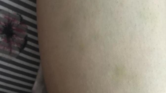 Vücutta durduk yere ortaya çıkan morluklar neden olur?