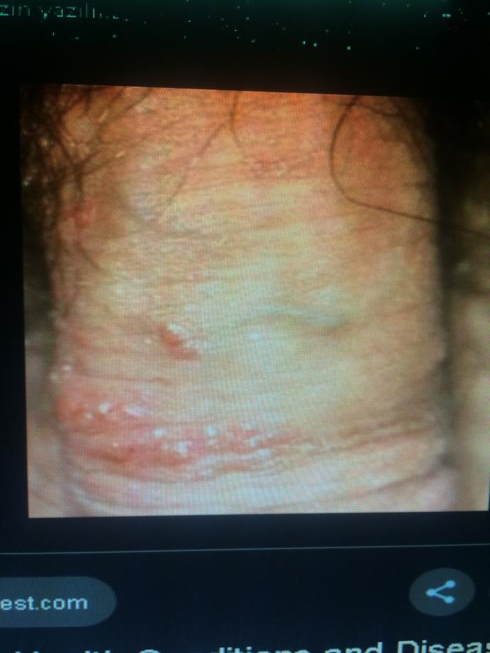 Erkek HPV
