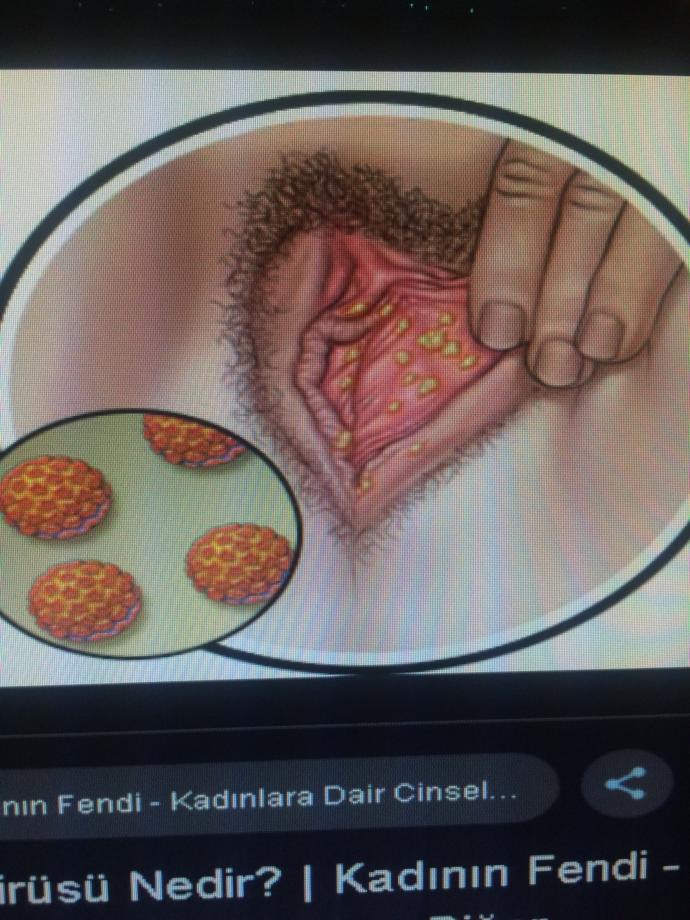 Kadın HPV