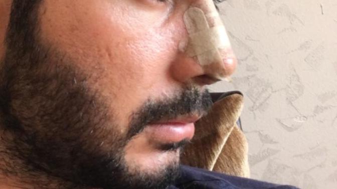 Burun ucu ödem azalınca zamanla bir miktar iner mi?
