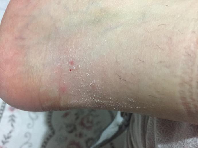Her yerimi bir şeyler ısırdı , sürekli kaşınıyorum ne yapacağım (Resimli)?