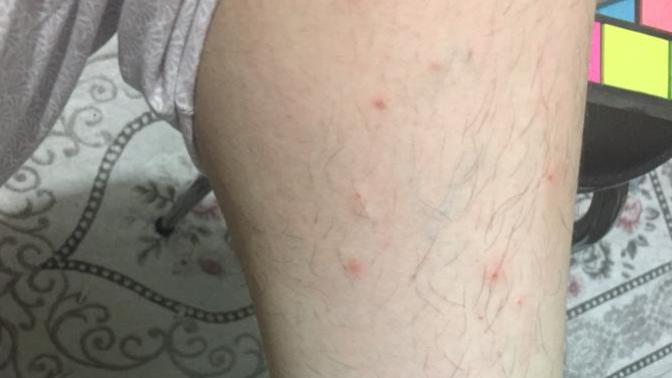 Her yerimi bir şeyler ısırdı , sürekli kaşınıyorum ne yapacağım (Resimli)?