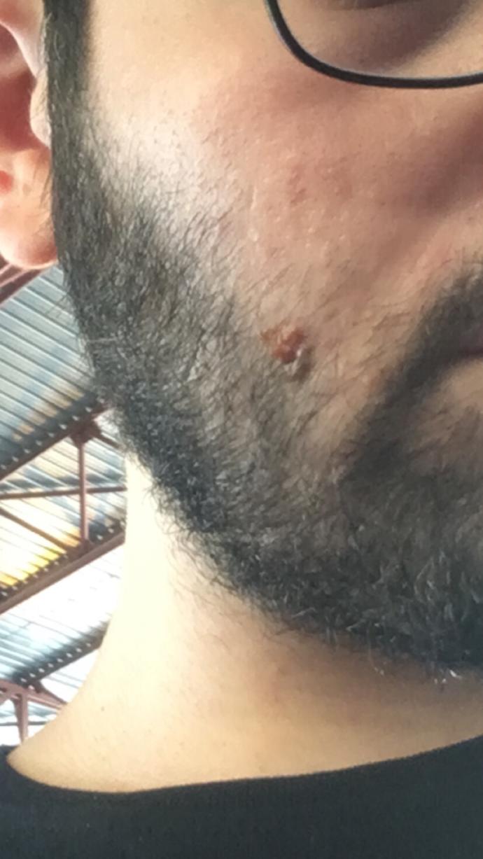 Yanağımda böyle bişey çıktı nasıl geçer bu?