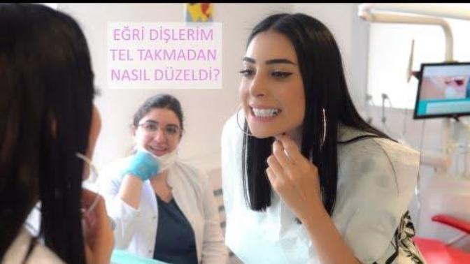 Diş çarpıklığı tel takmadan düzelir mi?