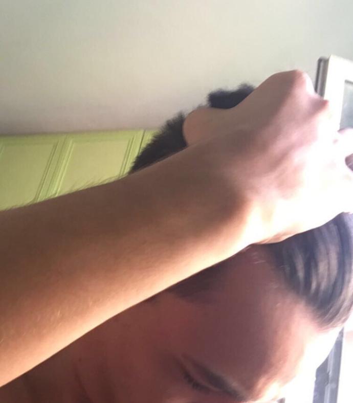 Hair line ım çok gerde?