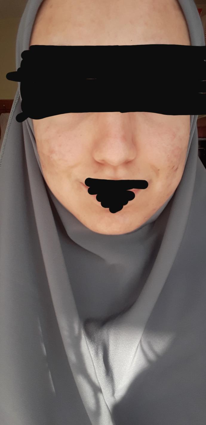 Sizce nasıl düzelir yüzüm? Düzelemeyecek kadar kötümü?