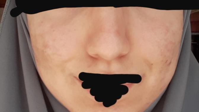 Sizce nasıl düzelir yüzüm? Düzelemeyecek kadar kötümü?
