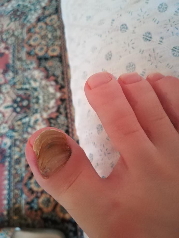 Tırnak Mantarı Niye Olur? Ne Zaman İyileşir?