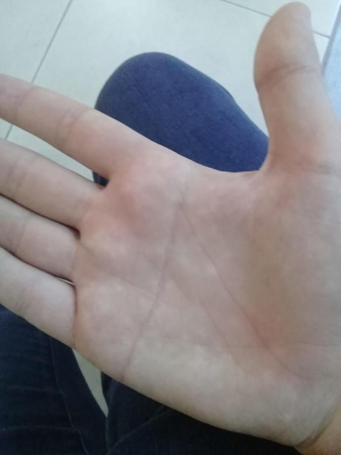Ellerimde beyaz lekeler? Normal mi?