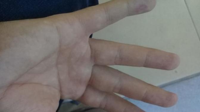 Ellerimde beyaz lekeler? Normal mi?
