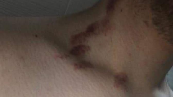 Boynumdaki morluklar nasıl geçer?