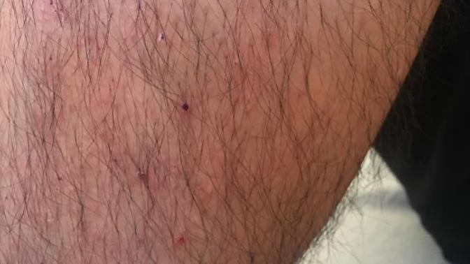 Abimin her yeri kaşınıyor, bacakları kaşımaktan yara oldu, doktorlar çare bulamadı, önerisi olan?