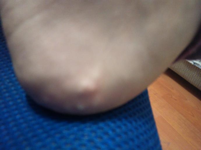 Ayağımda böyle şeyler var normal mi hastalık belirtisi mi?