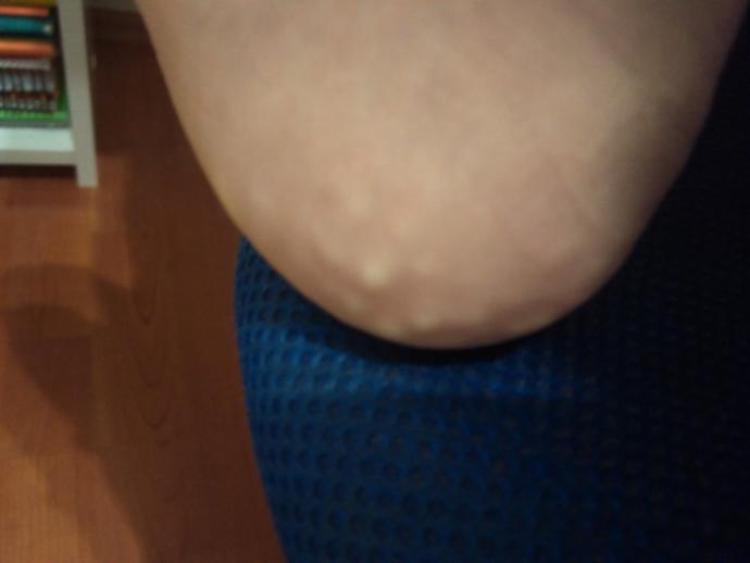 Ayağımda böyle şeyler var normal mi hastalık belirtisi mi?