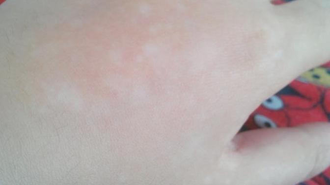 Erkekler, Sizce vitiligo itici mi?