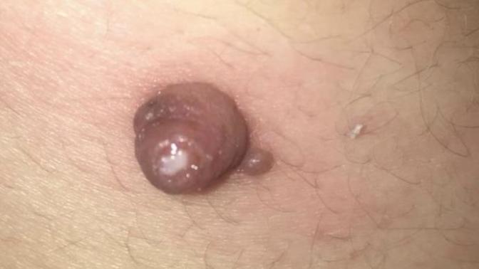 Sırtımda et beni var. Bugün de acıyor iltihap mı kapmış. Ne bu şimdi korkuyorum☹️?