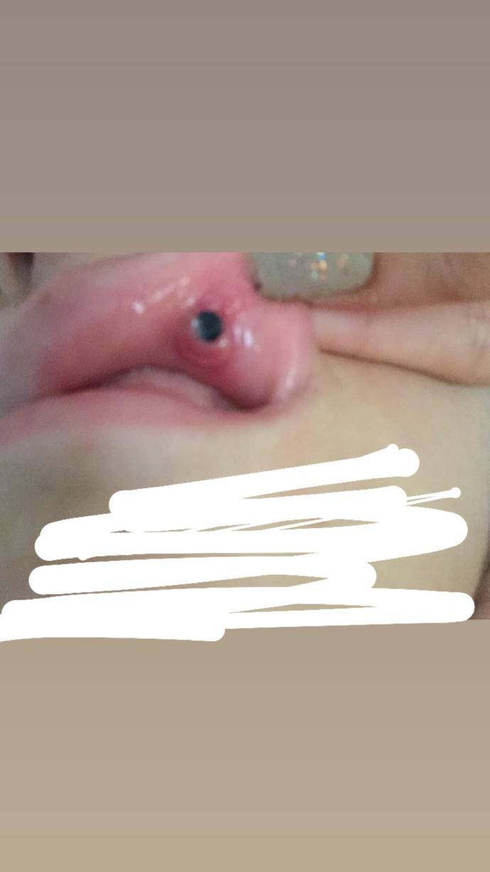 Dudak piercing yaptırdım 2 ay falan oldu böyle bişey oldu çıkmıyoda piercing acı falan yok ne yapmam lazım?
