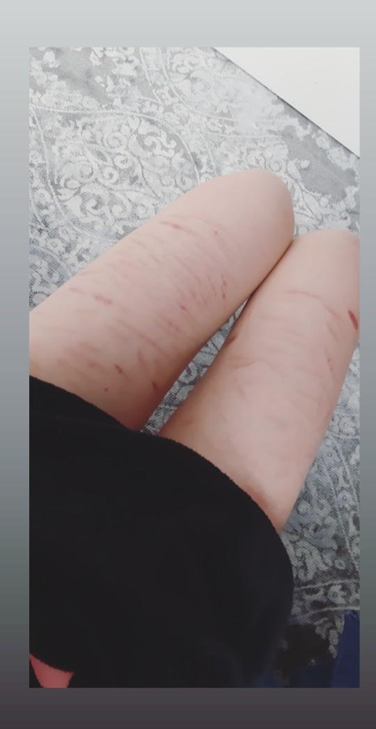 Faça izleri estetik ameliyat ile geçer mi hangi tedavi yöntemi ile tamamiyla geçer?