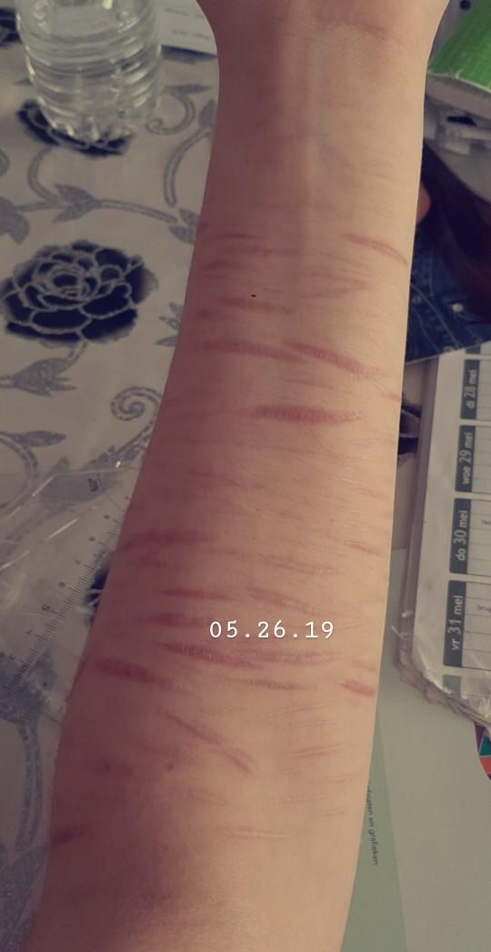 Faça izleri estetik ameliyat ile geçer mi hangi tedavi yöntemi ile tamamiyla geçer?