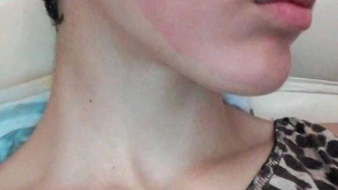 Arkadaşlar yüzüme maske yaptım yüzüm kıpkırmızı oldu nasıl geçirebilirim?