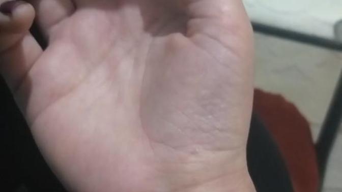 Derin yara izlerini hafifletmenin yolları neler?