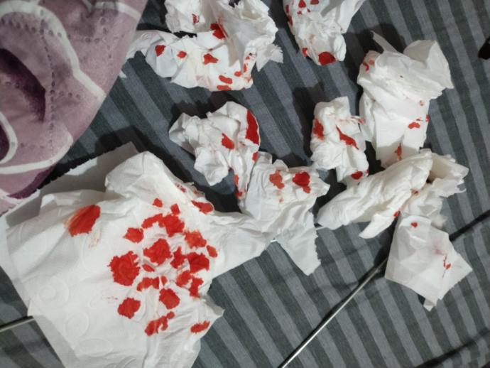 Dudağımı kestim durmuyor?