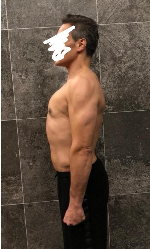 Liposuction fiyatları bilen ve liposuction yaptıranların yorumları nedir?