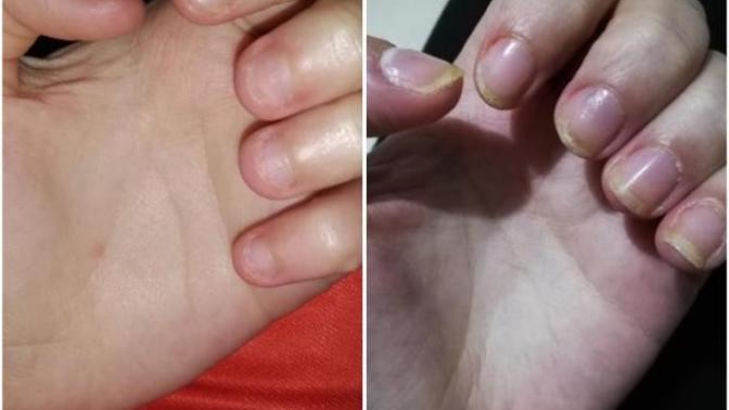 Çoğu insanın sorunu olan tırnak yeme hakkında?