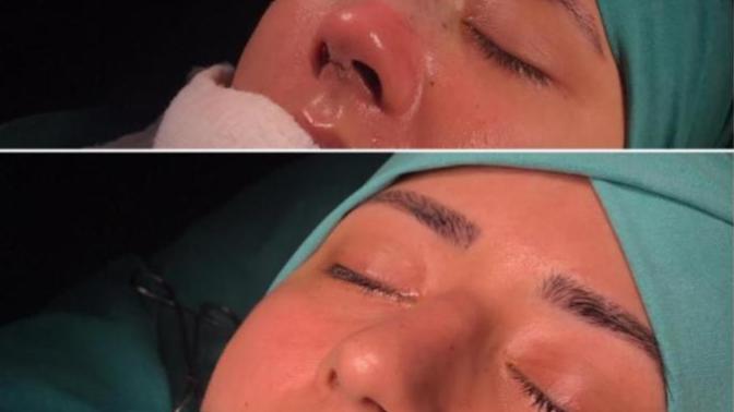 Burun ameliyatı ile ilgili sormak istediğiniz bir şey var mı?