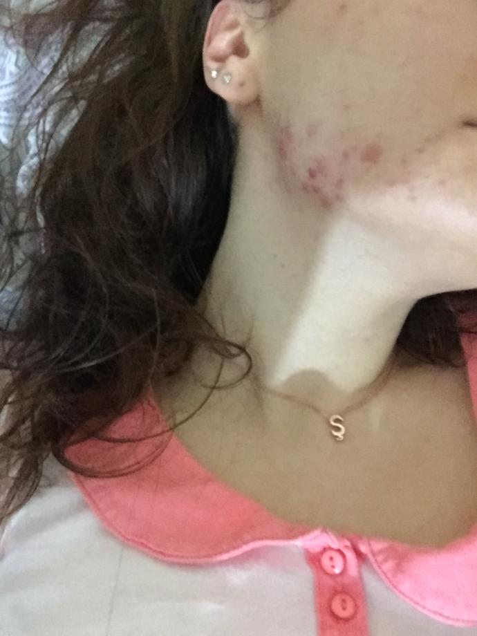 Stresten dolayı bu kadar sivilce normal mi 🙄?
