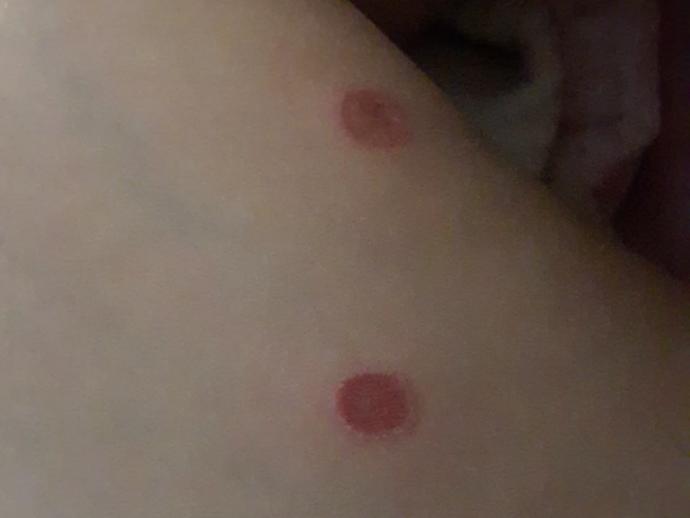 Bacağımda çıkan bu kırmızı lekelerin ne olabileceği hakkında bir fikri olan var mı?