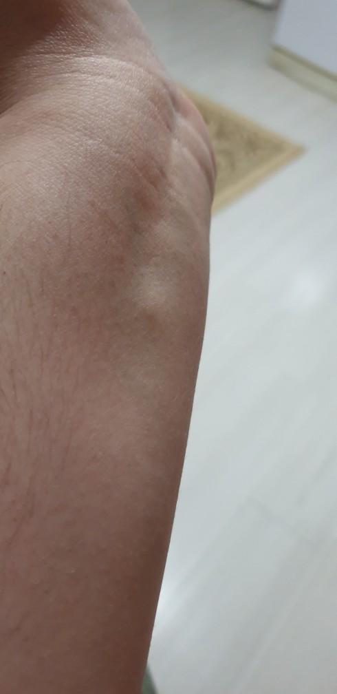 Spor sonrası kolumdaki bu şişlik neden olabilir?