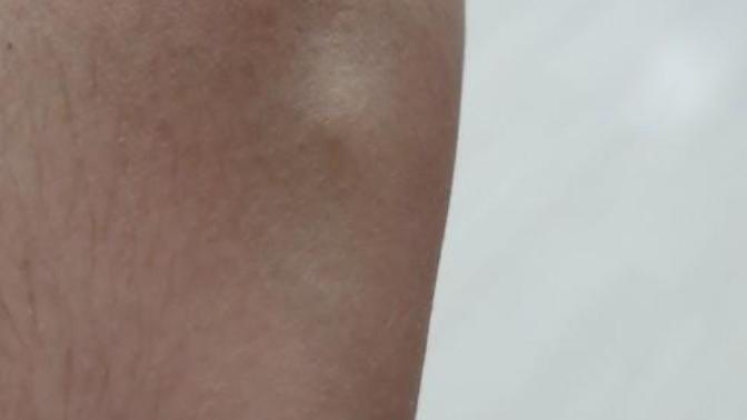 Spor sonrası kolumdaki bu şişlik neden olabilir?