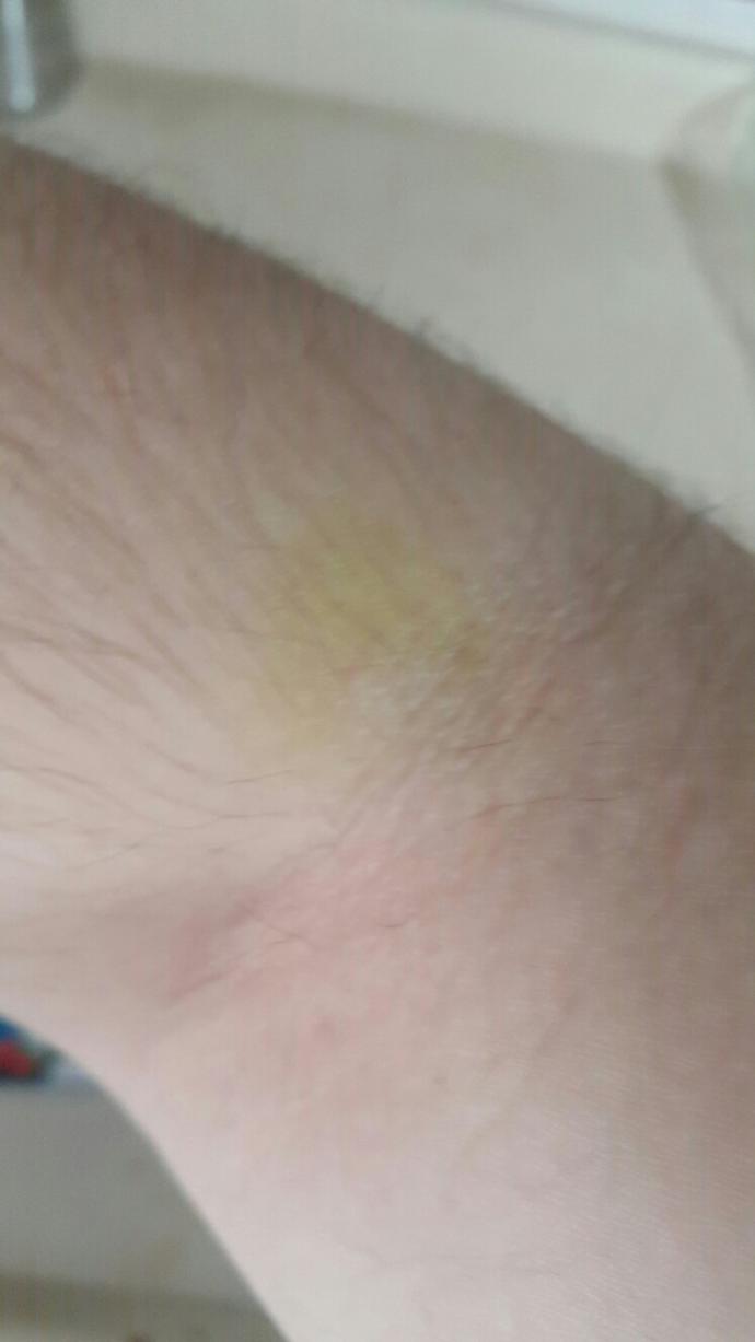 Kan alınan yerin sarı, yeşil karışımı renk olması normal mi?