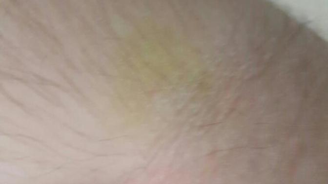 Kan alınan yerin sarı, yeşil karışımı renk olması normal mi?