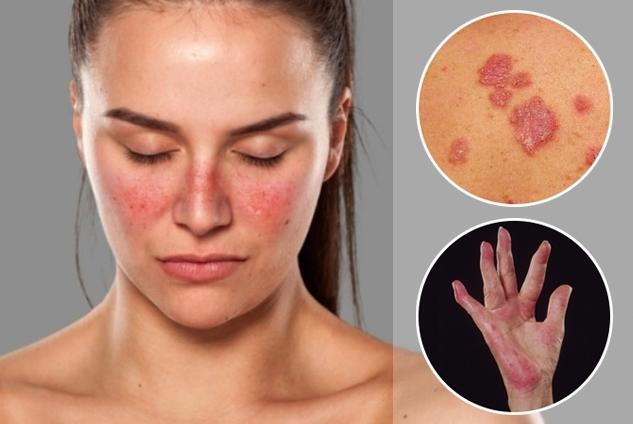 Lupus