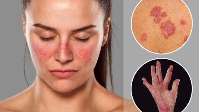 Lupus nedir, Lupus nasıl teşhis edilir?