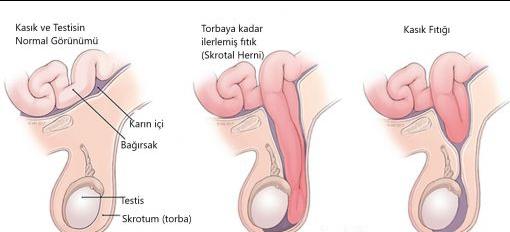 Kısaca belli deformasyonlardan dolayı bağırsak penise giriyor ve fıtik oluşuyor.