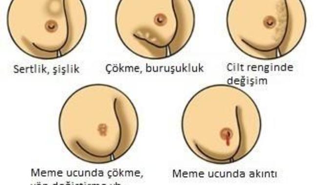 Meme kanseri taraması yaptırdınız mı?