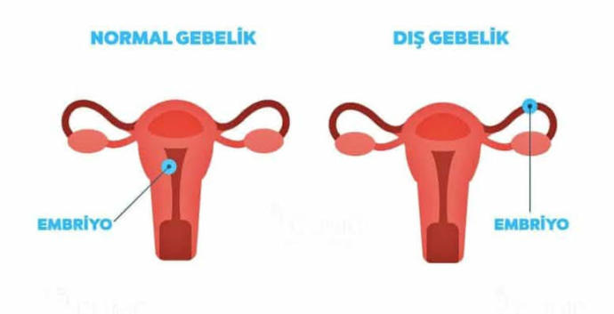 Dış gebelik 