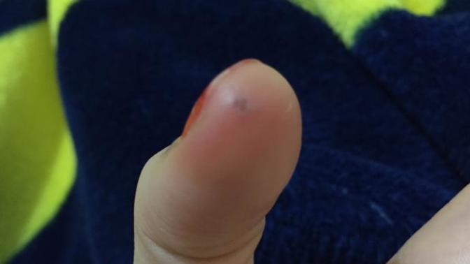 Acil buna bakar mı? parmağıma bişey batmış ne olduğunu bilmiyorum?