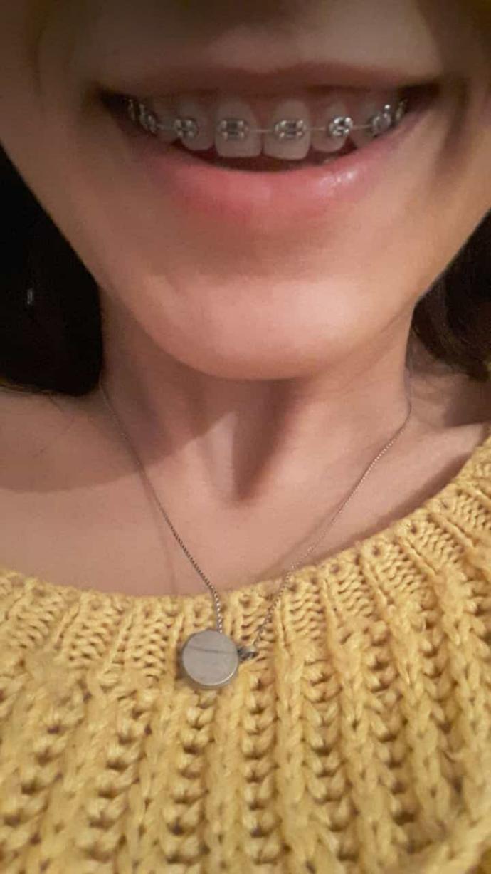 Diş teli varken diş temizliği nasıl yapılmalı? Dişlerimim son hali?