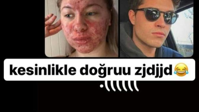 Erkeklerin cildi neden bizden daha güzel acaba?