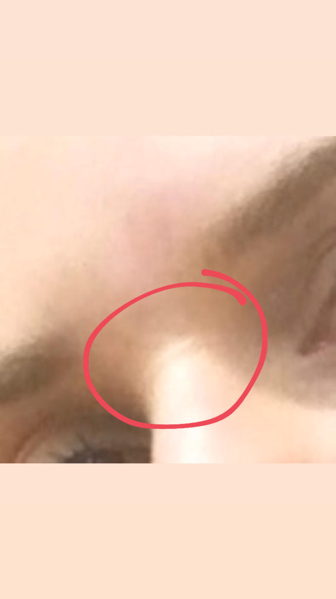 Burunda oluşan çizgi?