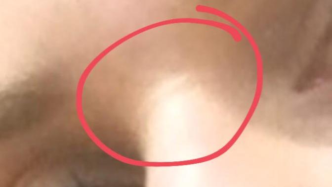 Burunda oluşan çizgi?