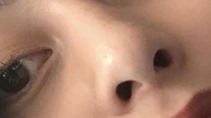 Burun ucu ameliyatı?