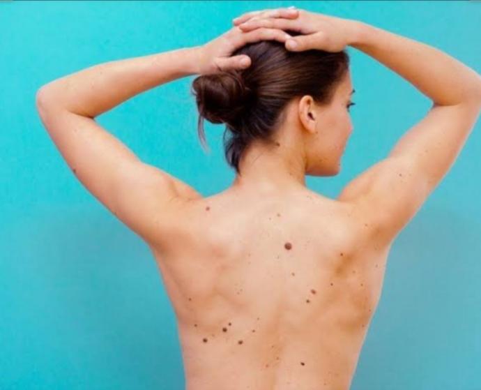 Kadınlarda ki  benler seksi midir, yoksa itici midir?